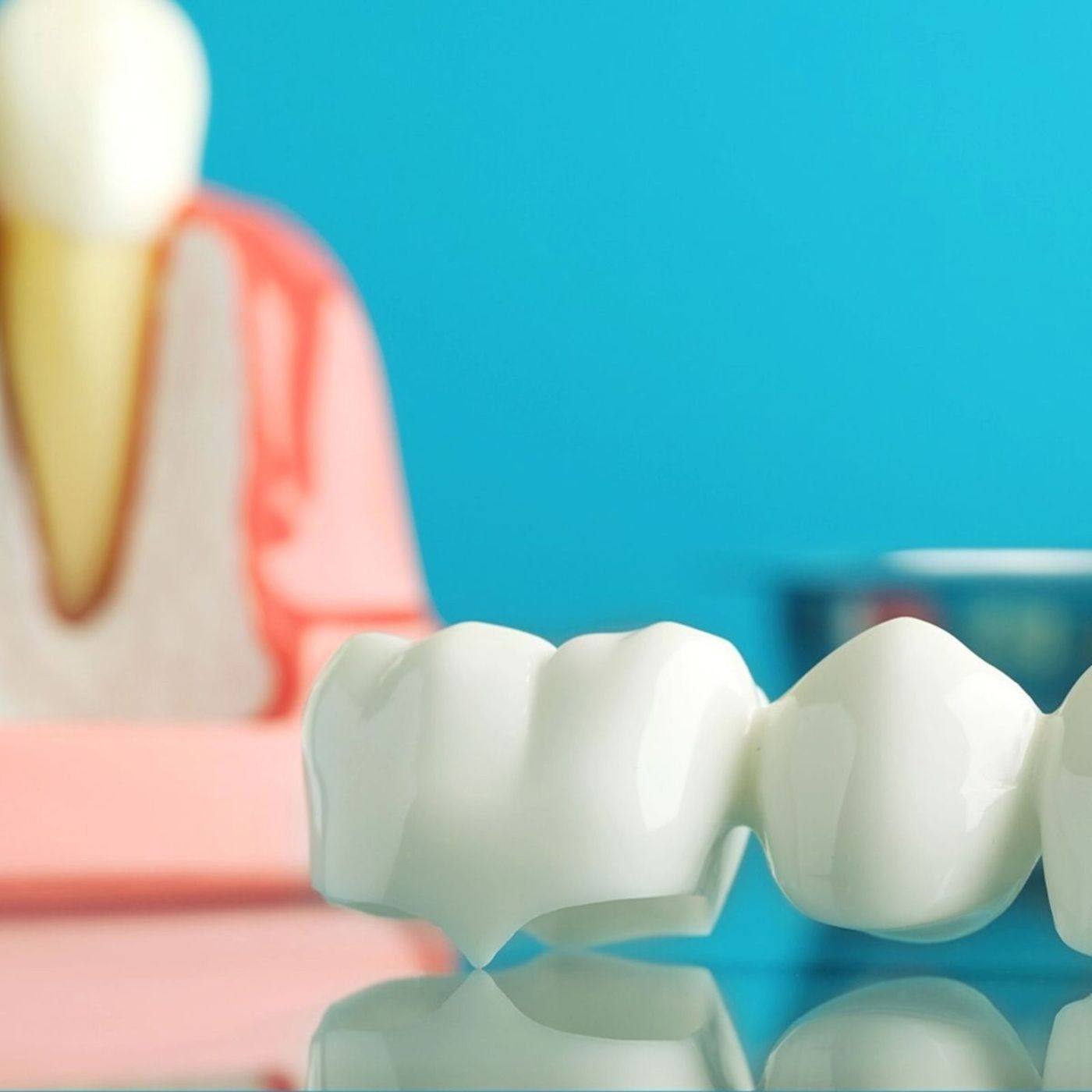 Close-up of porcelain dental crown bridge with tooth anatomy model